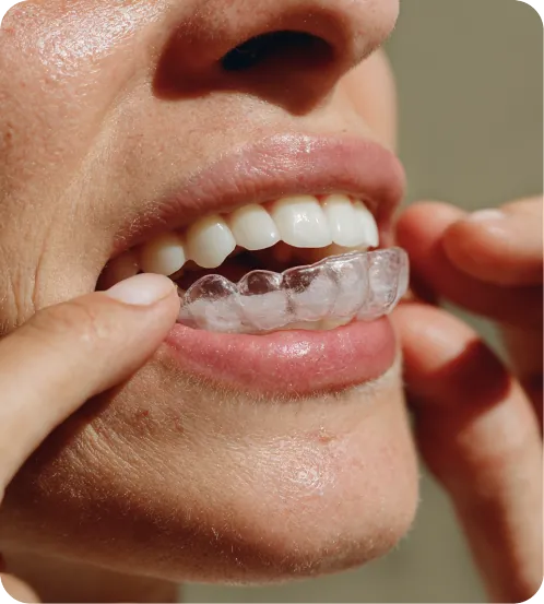 Person applying a clear aligner over their teeth