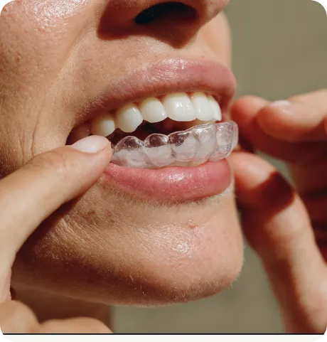 Person applying a clear aligner over their teeth